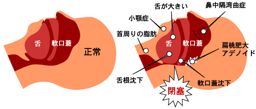 睡眠時無呼吸症候群とは